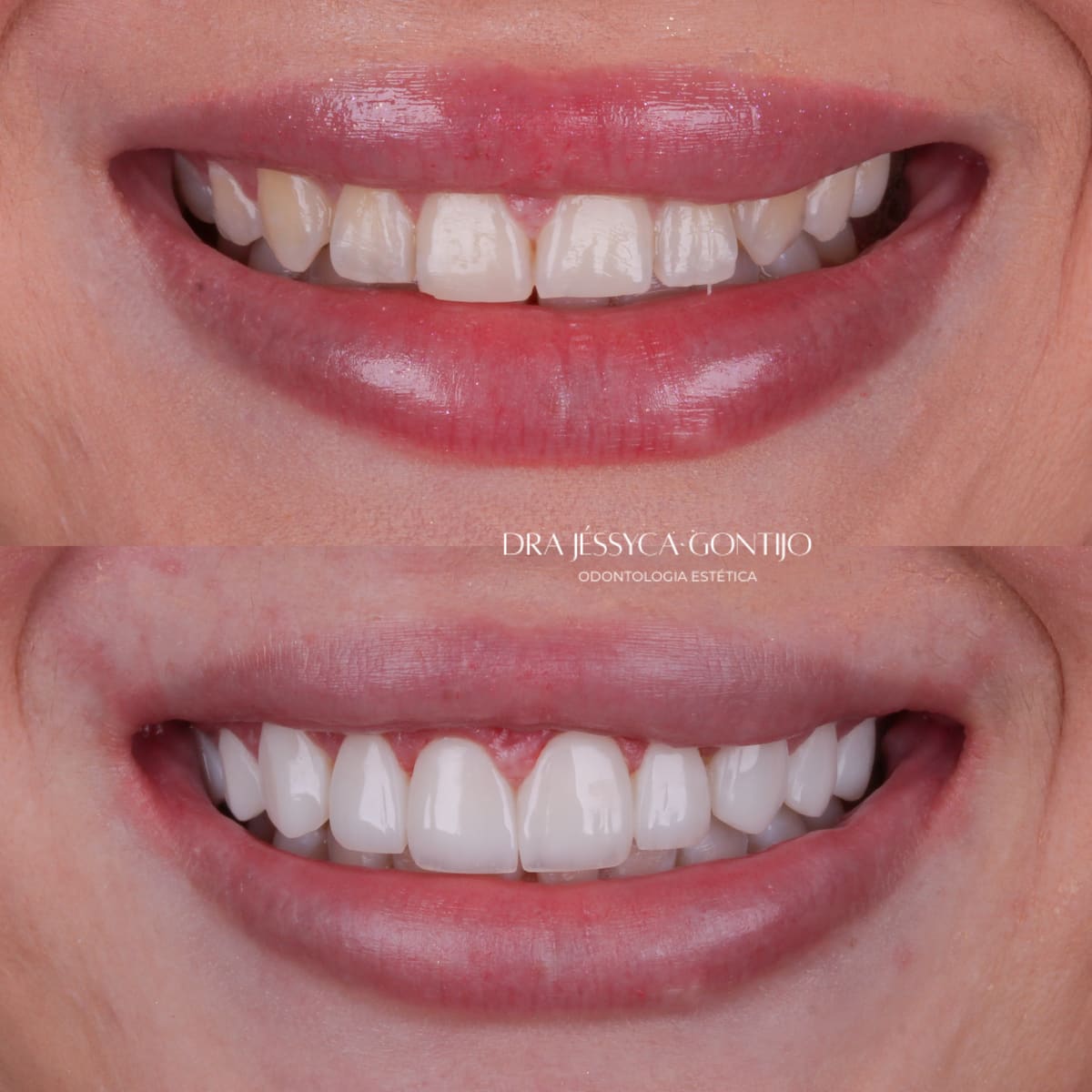 Antes e depois, caso 5