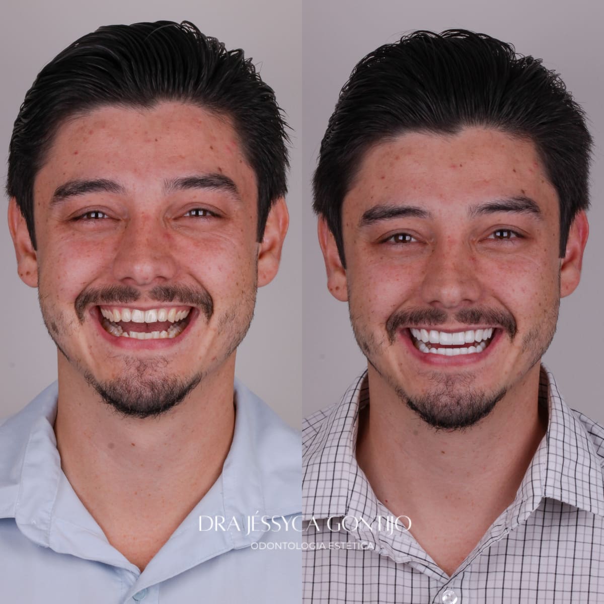 Antes e depois, caso 3