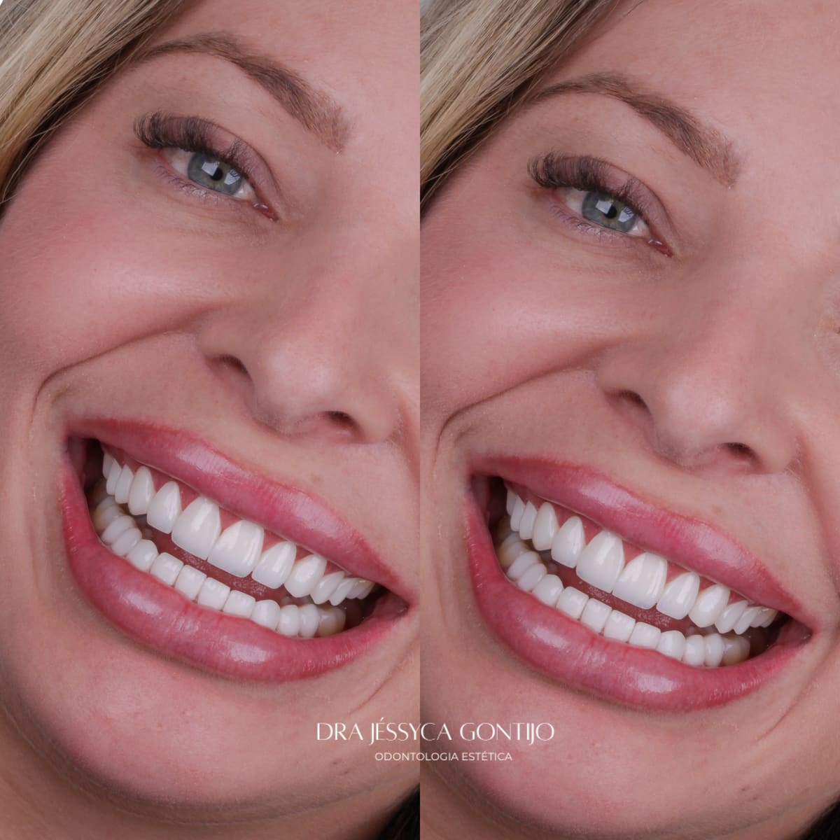 Antes e depois, caso 7