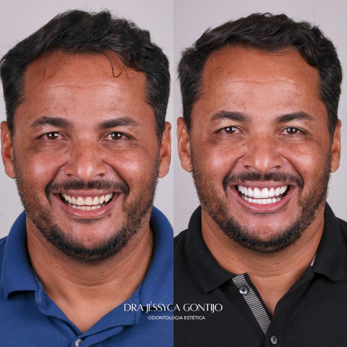 Antes e depois, caso 6